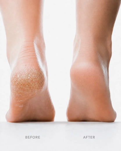 Feet before and after Velvet Heel Pro